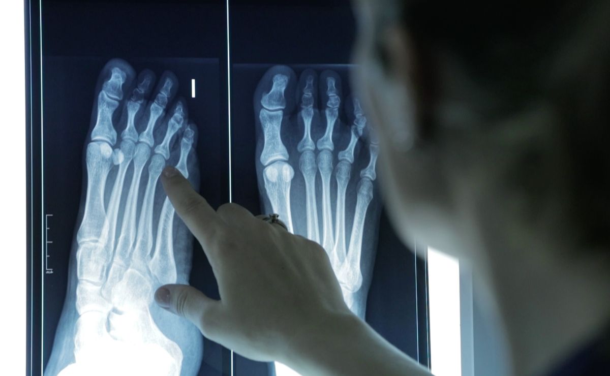 Dedos en martillo y en mazo: una deformidad común que afecta más a mujeres